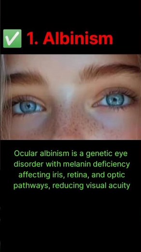 Albinism in Eye | Ocular Albinism | Causes, System & Treatment Explained by Doctor #eyes #facts