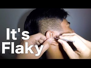 Removing Man's Dry & Flaky Earwax Using An Ear Curette
