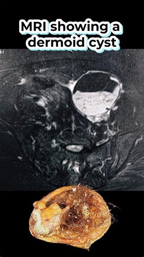MRI showing a dermoid cyst.