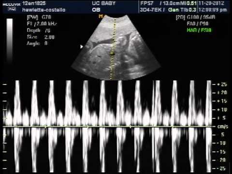 Baby boys heart beat 25 weeks 3d ultrasound nov 20 2012