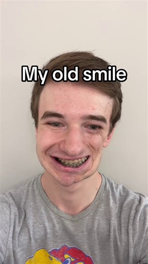 How do you like my new smile? 😁 #bracesoff How do you like my new smile? 😁 #bracesoff | Lukas Caldwell