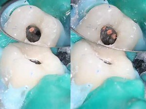 The use of CBCT scans in Endodontics