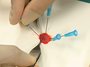 Minced Tissue in Compressed Collagen: A Cell-containing Biotransplant for Single-staged Reconstructive Repair