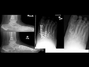 Foot reconstructive options with ORIF fails