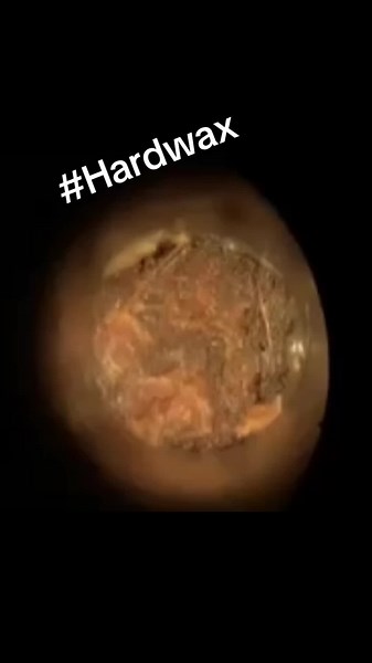 Earwax Removal: Understanding Rock Hard Wax
