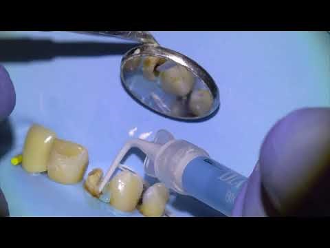 [34] Live Root Canal Retreatment Procedure