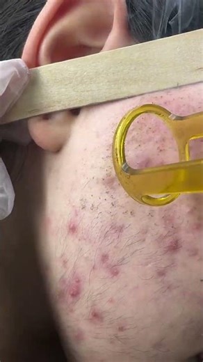 ازالة الشعر نهائيا بالليزر | laser hair removal