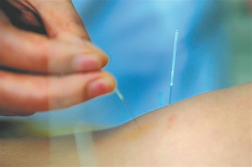 Using needles to help life's energy flow