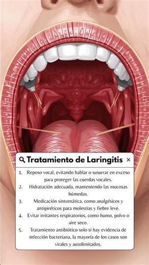 ¿Como tratar la laringitis? #laringitis #dolordegarganta #medicina #salud