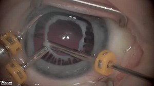 23-Gauge Plaque Dissection of Anterior Persistent Fetal Vasculature in a 2-week-old Boy - Eyetube