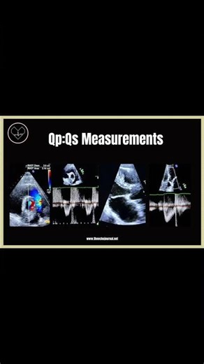 Qp:Qs in Echocardiography