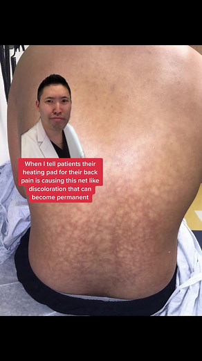 Understanding Erythema Ab Igne: Causes and Treatment Options