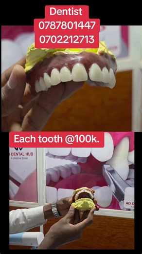 Affordable Artificial Teeth Replacement Options in Kampala