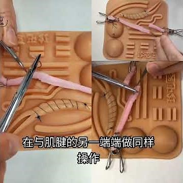 Basic training 64 Modified Kessler suture technique for tendon repair