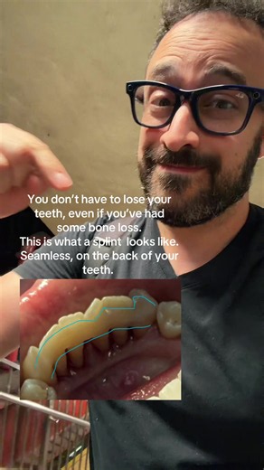 When your lower front teeth need LANAP but have lost a significant amount of bone, we’ll use a splint to secure the teeth in place while the bone and attachment heal and regenerate! #oralcare #dentalcare #teethcare #gums #gumdisease