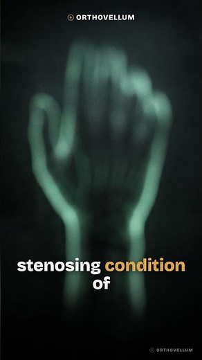 De Quervain Tenosynovitis: 1st Dorsal Compartment Masterclass