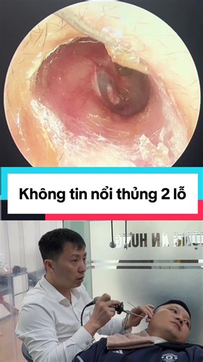 Thủng màng nhĩ 2 lỗ