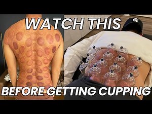 If you have these 5 signs, don't get cupping (it can do more harm)