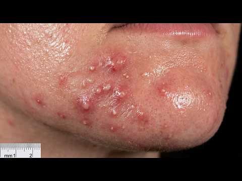 Loan Nguyen Acne Treatment 41ll