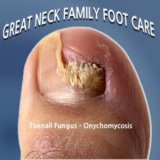 vaporub for toenail fungus