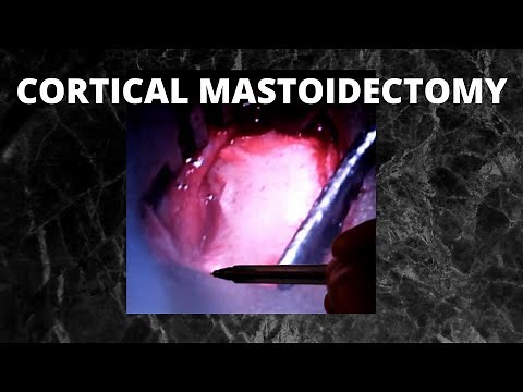 069. Cortical Mastoidectomy #Schwartz's operation #surgeryeducation