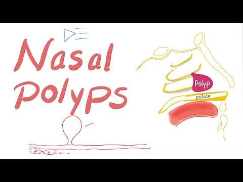 Nasal Polyps (Allergic Rhinitis and Cystic Fibrosis)