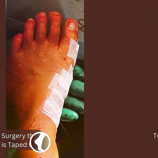 Hallux Valgus surgery with Minimally Invasive Technique (MIS/MICA) - 16 Weeks Results