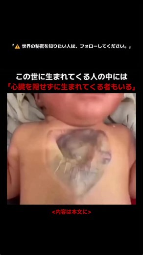 ミステリーワールド｜事件・事故の記録 on Instagram: "先天性胸骨無形成とは、 生まれつき胸骨が部分的、または完全に存在しない 非常にまれな先天性奇形です。 この疾患は、胎児の発育過程で 胸骨を形成する左右の構造が 正常に融合しなかったことによって起こります。 その結果、胸の中央に細い隙間が生じたり、 重症の場合は胸骨そのものが まったく形成されない状態で出生します。 外見上は、 単なる胸郭の異常に見えることもあります。 しかし実際には、 極めて危険な状態です。 胸骨が存在しないということは、 心臓や重要な臓器を守る 「骨の盾」がないことを意味するからです。 そのため心臓は 外部からの衝撃に直接さらされ、 症例によっては 心臓が胸郭の外へ突出する 心臓外反症を伴うことも報告されています。 医学的には非常に稀な疾患で、 多くの場合、出生直後、 あるいは妊娠中の超音波検査によって発見されます。 治療の中心となるのは外科的矯正です。 人工的な再建手術によって胸壁を形成し、 心臓や臓器が 安定した位置に保たれるようにします。 この病気は、 単なる骨の欠損ではありません。 それは、生