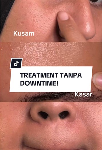 Treatment Skin Barrier Healer sebelum tahun baru🥰