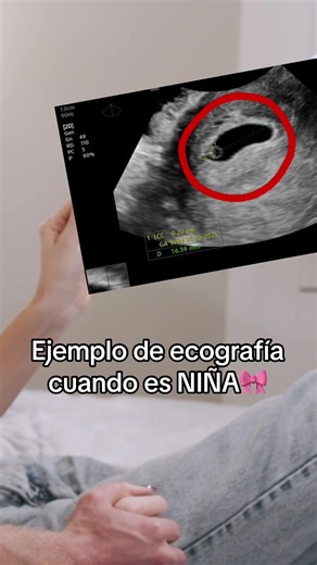 Ejemplo de ecografía para niñas con el método Ramzi