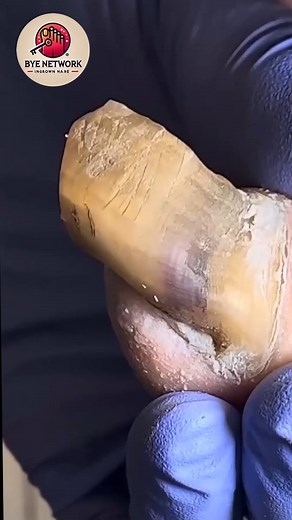 Cracked toenail routines without cutting or strong filing steps ☺🥭 #CrackedNailCare #SafeNailCare #GentleToenailCare | Bye