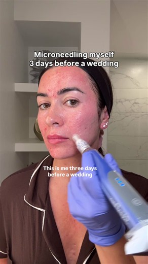 Microneedling: unhinged edition 🤪 Follow to see my update in 3 days! Let’s see if I’m right to believe using exosomes will have my skin back to normal by the time I attend a wedding this weekend 🙈 #microneedling #exosomes