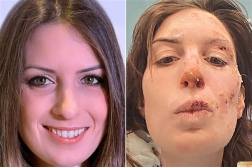 Eleonora Palmieri reveals her scars to the world as Elsa emerges from a 22-day coma - greenMe