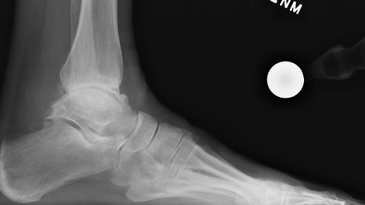 Vantage Ankle Operative Technique Surgical Video