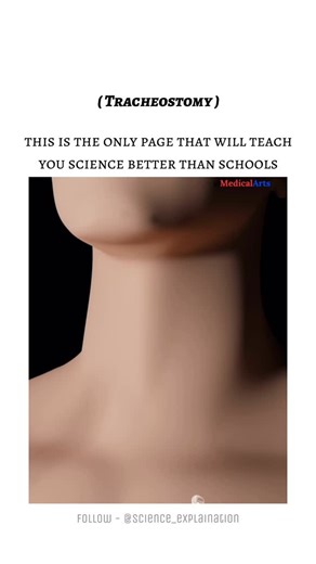 Science on Instagram: "A tracheostomy is a surgical procedure in which an opening (stoma) is created in the trachea (windpipe) through the neck to allow direct passage of air into the lungs. A tracheostomy tube is inserted into this opening to maintain the airway. • Purpose: To bypass upper airway obstruction, assist in long-term ventilation, clear secretions, or provide airway access during certain surgeries. • Indications: Severe trauma, tumors, infections, congenital abnormalities, prolonged 