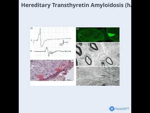 Neuropathies Demyelinating, Dysmyelinating, and Axonal