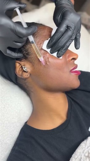 MESOTHERAPY Mesotherapy works in the superficial layers of the skin, right where hydration,