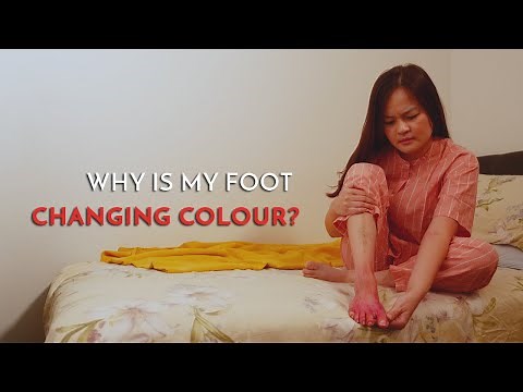 Why is my foot changing colour? - Podiatrist Georgina Tay, East Coast Podiatry