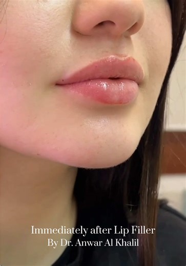 After Lip Filler: Beautiful Natural Lip Transformation