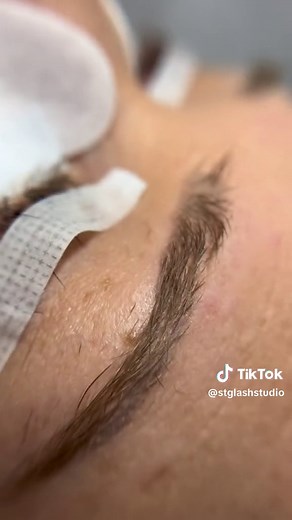 Demodex Blepharitis: The Dangers of Dirty Lashes