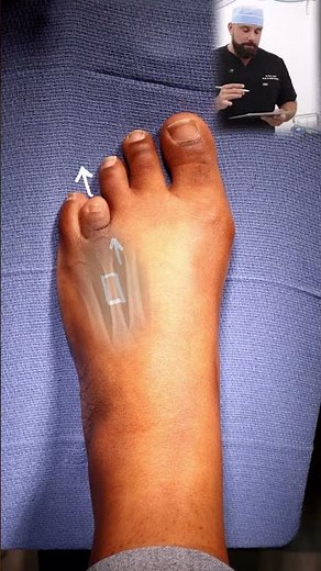 Have you seen a tiny toe before Here’s how we fix it! #luxefootsurgery #toelengthening #tinytoe