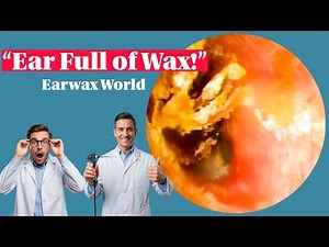 033- Painful Otitis Externa Caused by Earwax Blockage | Real ENT Cleaning Case - Earwax World