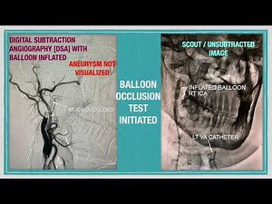 Balloon Occlusion Test Carotid Occlusion