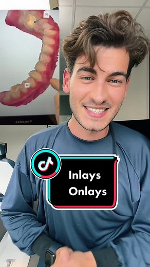 On appelle ça des inlays/onlays 👆insta: docteur.kevin #dentiste