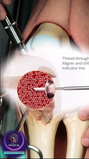 Articular Cartilage Repair of the Knee Joint | Surgical Procedure Animation