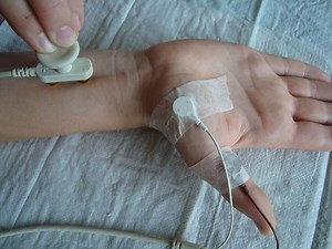 Nerve conduction study - Alchetron, The Free Social Encyclopedia