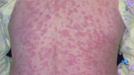 Virginia confirms second measles case of 2026; exposure sites listed