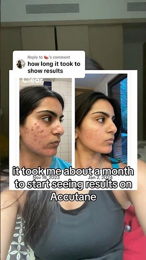 Here’s how long it took me to start seeing results on Accutane. #acne #accutane #dermatology
