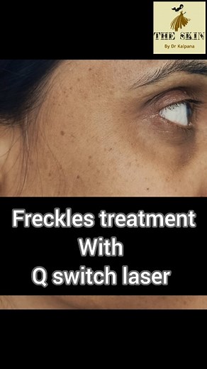 Freckles treatment As you can see in video Q switch Nd yag laser is a very safe and effective method for treatment of freckles .Watch the video to know more about the procedure and precautions involved. If you have freckles,you should consult your skin specialist If you want to do online consultation with us you can WhatsApp on 8368019249 if you want to come and visit us for consultation kindly visit us at ARV Aesthatics skin and laser clinic 240 ,sapphire Mall sector 49 Gurgaon Haryana For more