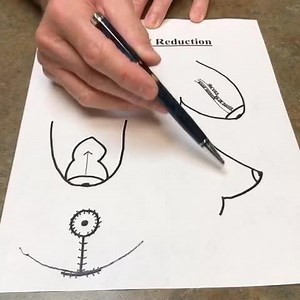 Breast reduction #2, The procedure